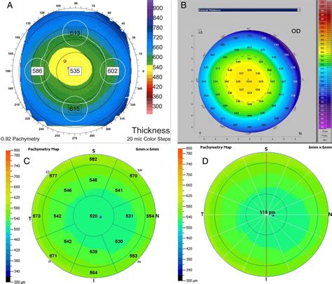 measurement of the thickness of the cornea is known as|corneal thickness pachy chart.